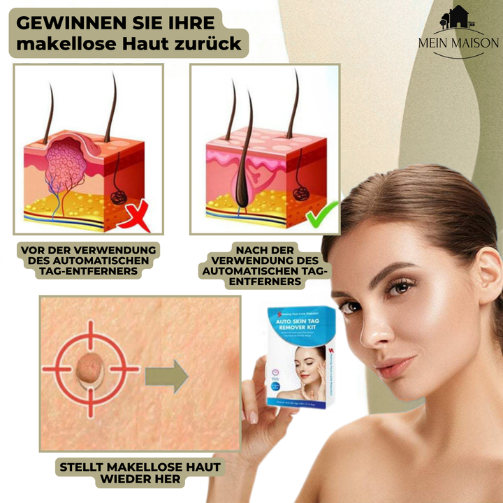 DermaLinx Usuwacz Brodawek | Bezbolesne usuwanie brodawek i znamion | Do domu | Bez operacji