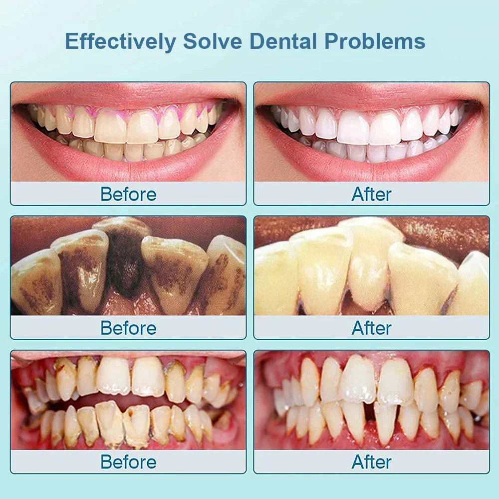 Ultradźwiękowy skaler do zębów - SonicClean