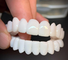 Nakładki na zęby DentAlign – naturalne dopasowanie i komfort