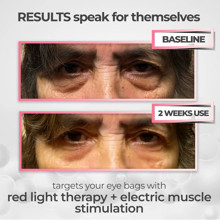 LumaNova Eye Rejuvenator do terapii światłem czerwonym i mikroprądem