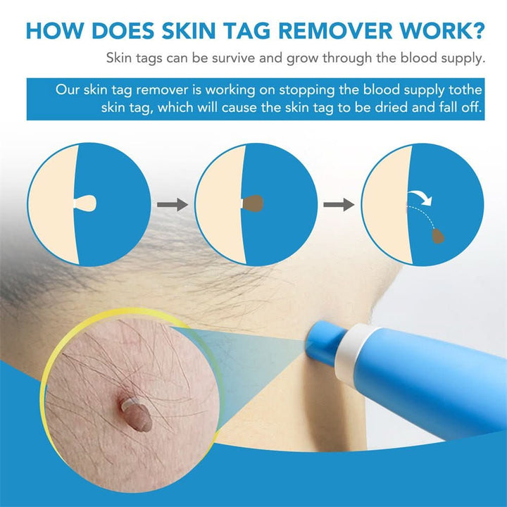Dermaswift – Usuń przebarwienia skórne, brodawki i narośla skórne