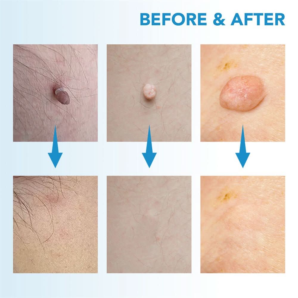 Dermaswift – Usuń przebarwienia skórne, brodawki i narośla skórne