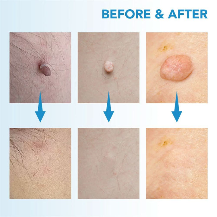 Dermaswift – Usuń przebarwienia skórne, brodawki i narośla skórne